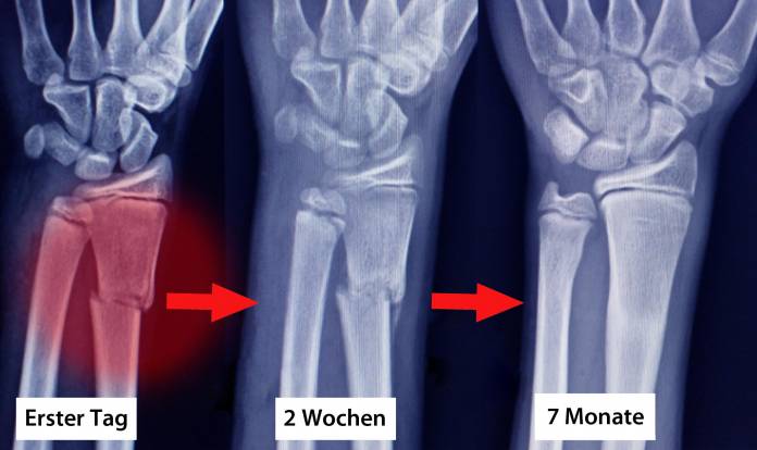 Röntgenaufnahme einer distalen Radiusfraktur