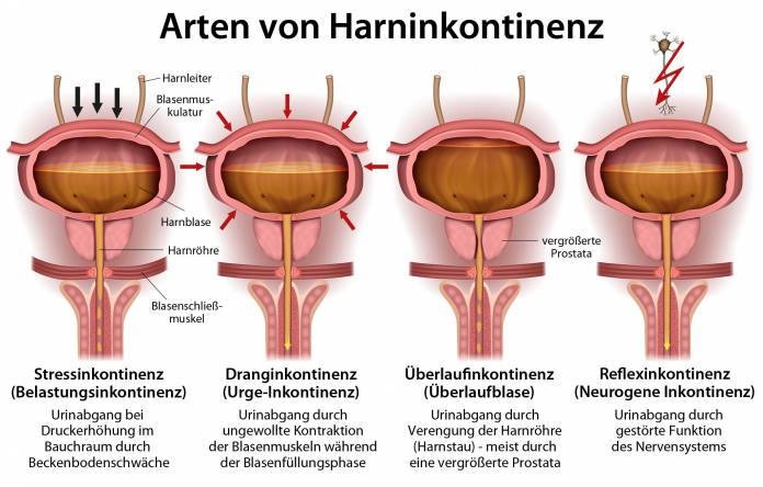 Arten von Harninkontinenz