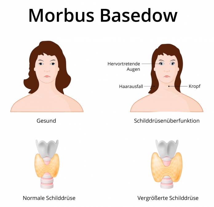 Morbus Basedow
