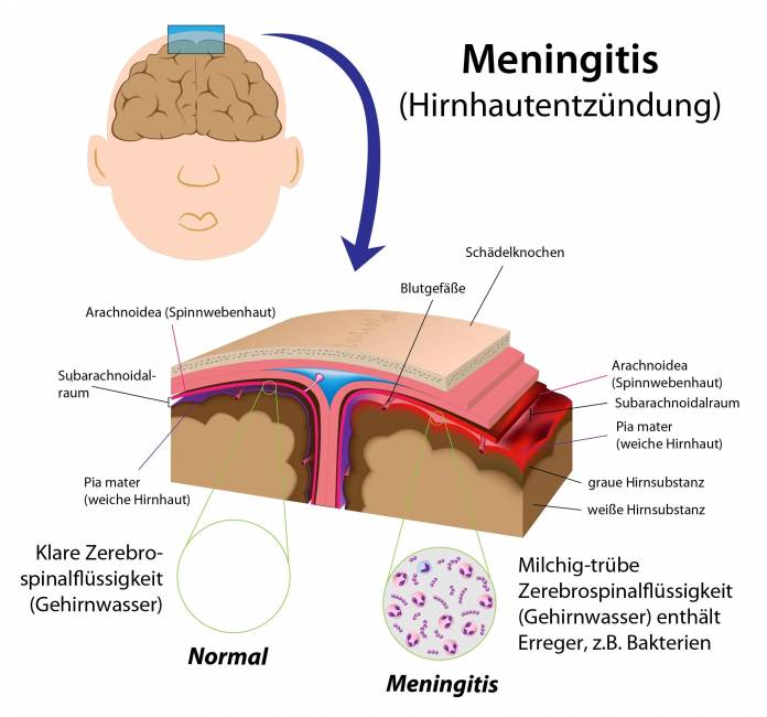 Meningitis (Hirnhautentzündung)