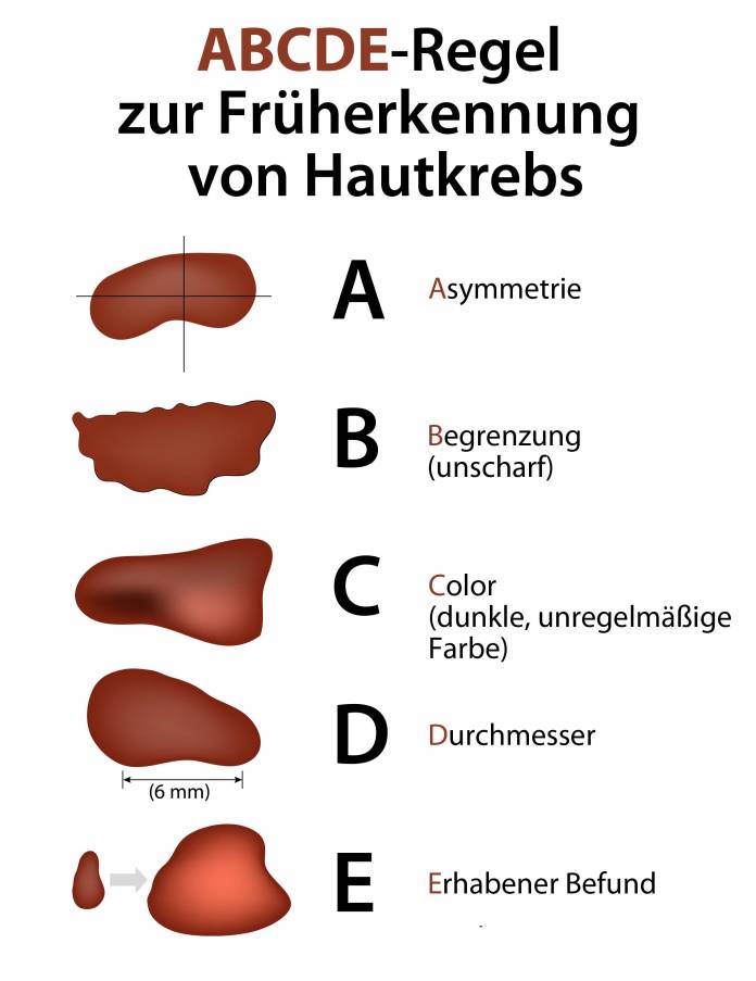 Wie Unterscheidet Sich Ein Leberfleck Von Hautkrebs 