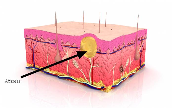 Abszess - abgekapselte Eiteransammlung