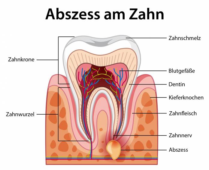 Abszess am Zahn (Dentalabszess)