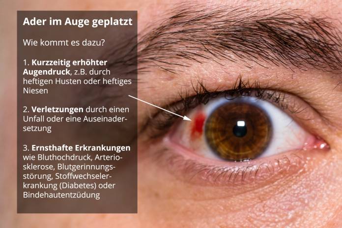 Ader im Auge geplatzt