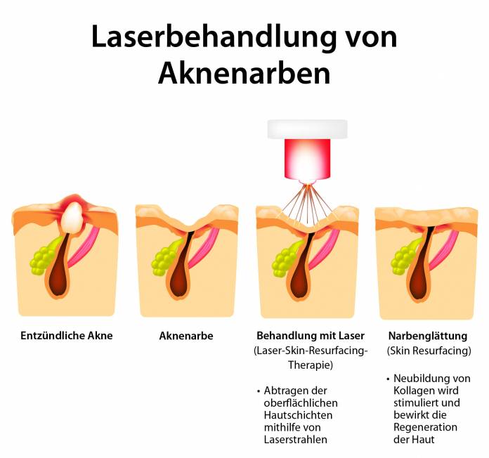 Behandlung von Aknenarben mithlife des Lasers