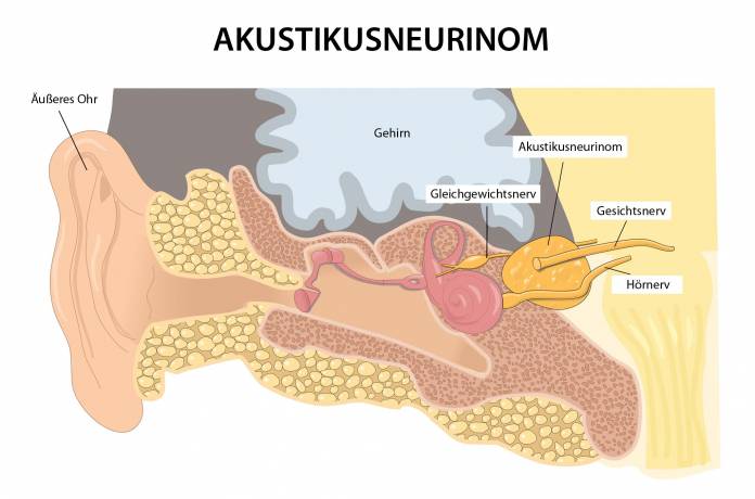 Akustikusneurinom