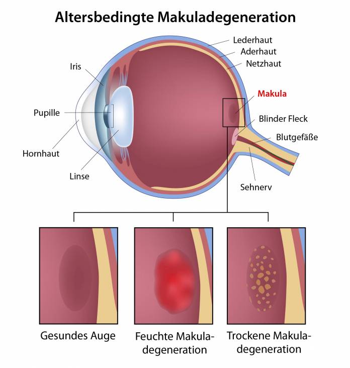 Altersbedingte Makuladegeneration