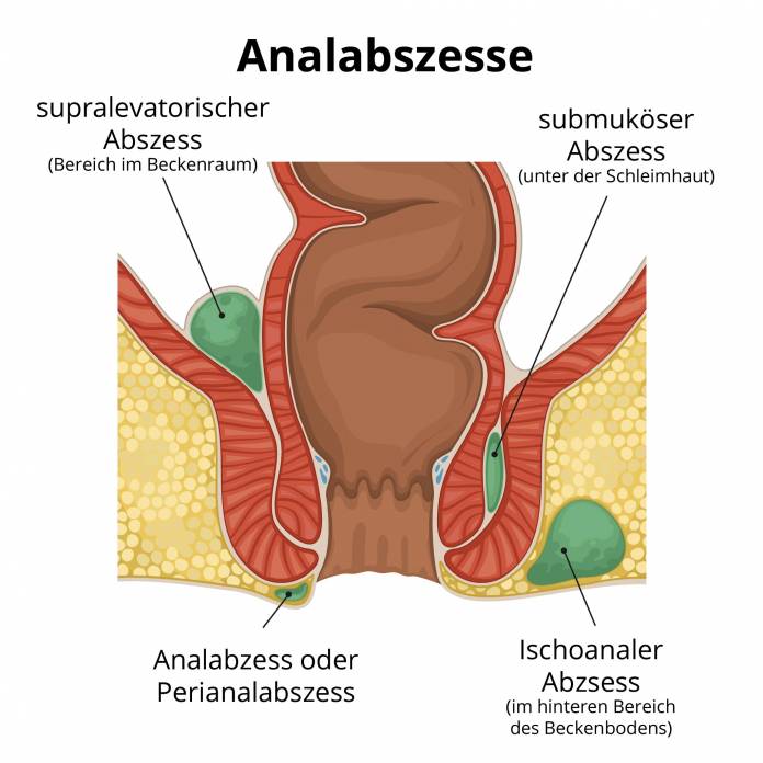 Analabzesse