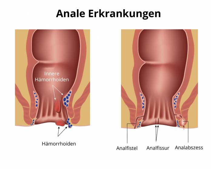 Anale Erkrankungen