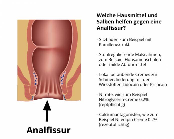 Analfissur Hausmittel und Salben