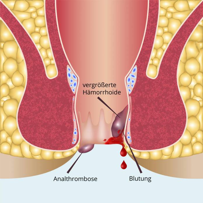 Lage von Analthrombose und Hämorrhoiden