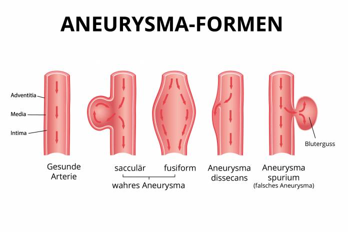 Aneurysma Formen