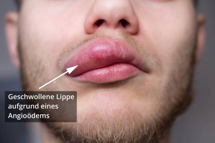 Angioödem Lippe