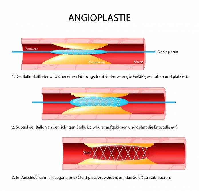 Angioplastie (Ballonerweiterung)