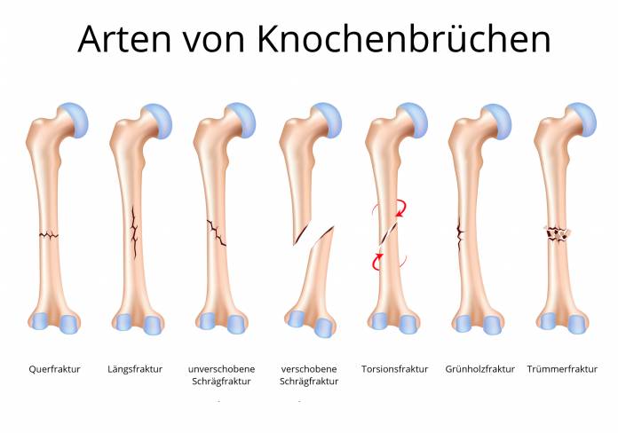 Arten von Knochenbrüche