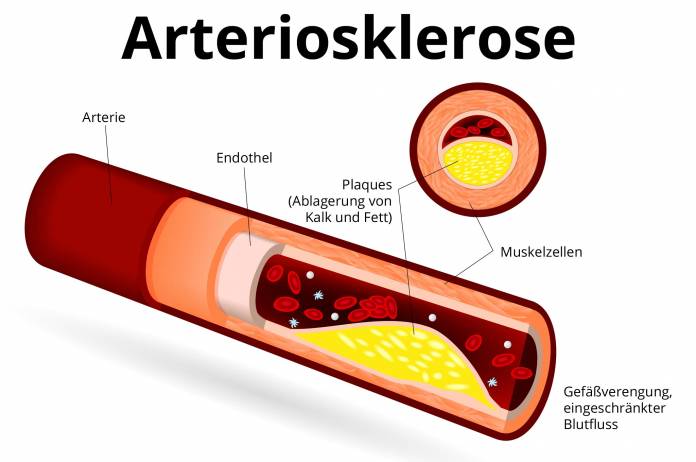 Arteriosklerose