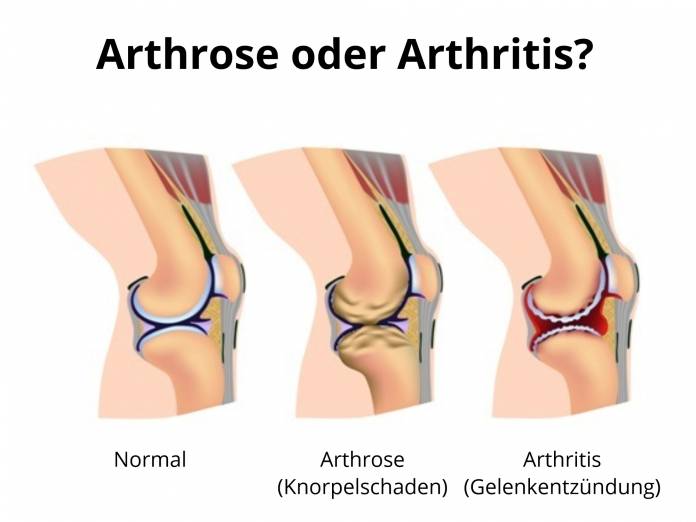 Der Unterschied zwischen Arthrose und Arthritis