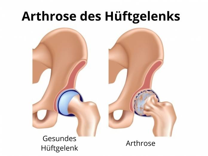 Arthrose Hüftgelenk