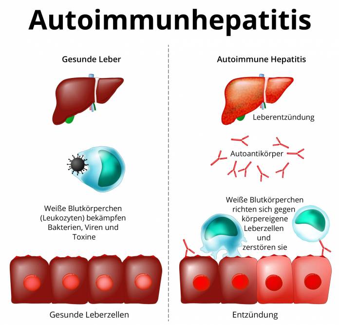 Was ist die autoimmune Hepatitis und wie wird sie behandelt?