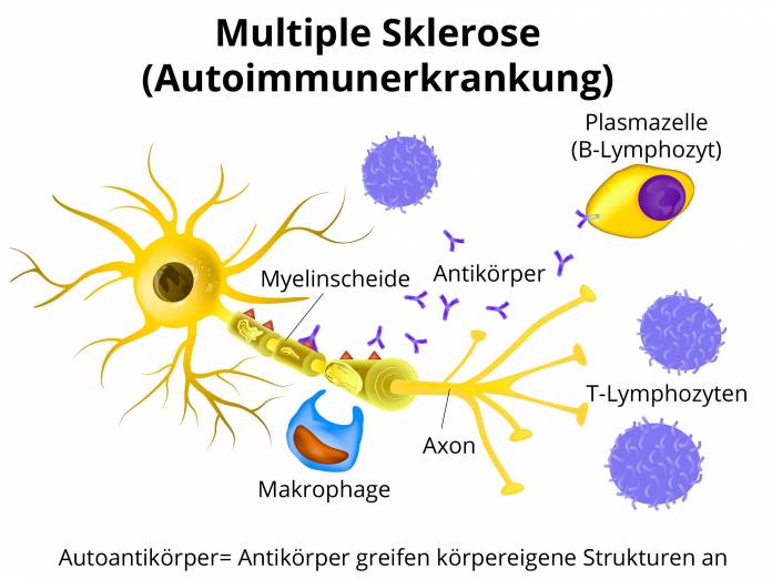 Autoimmunkrankheit Multiple Sklerose