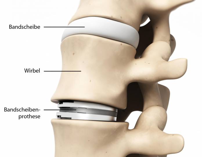 Bandscheibenprothese
