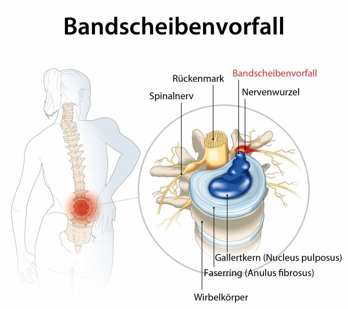 Bandscheibenvorfall