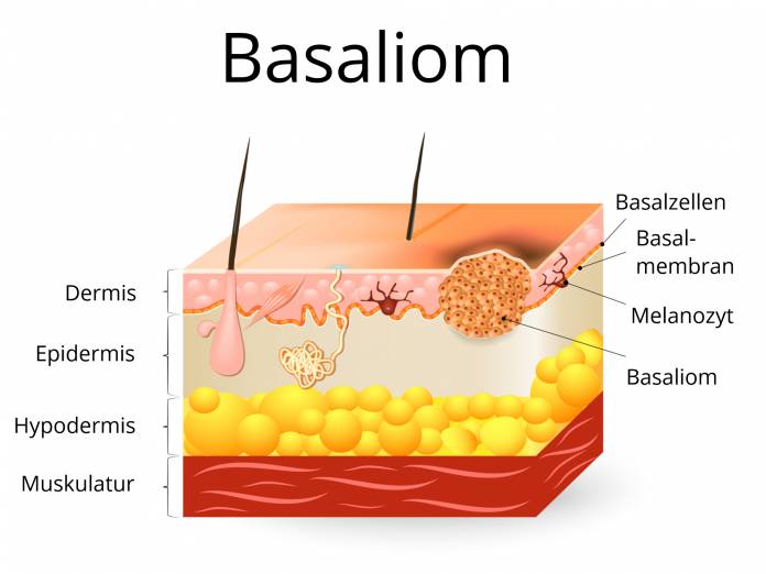 Basaliom