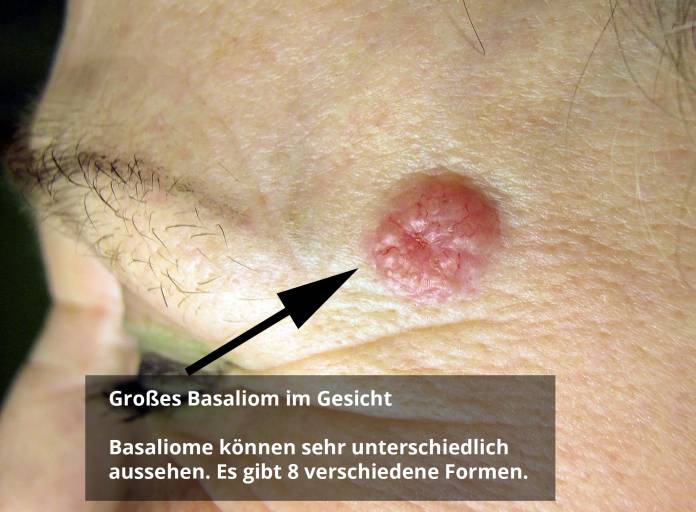 Diagnose eines Basalioms