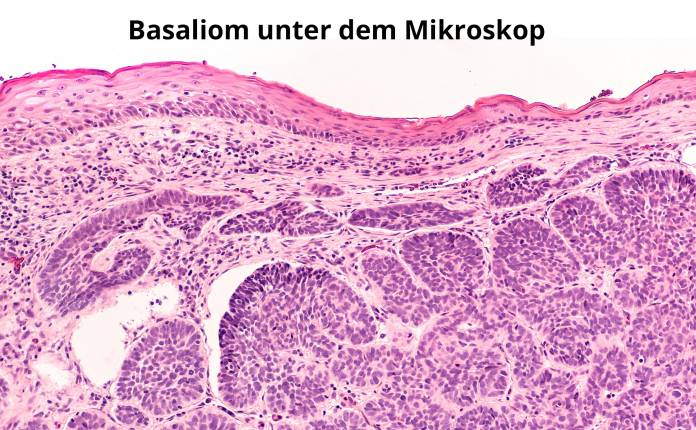 Basaliom unter dem Mikroskop