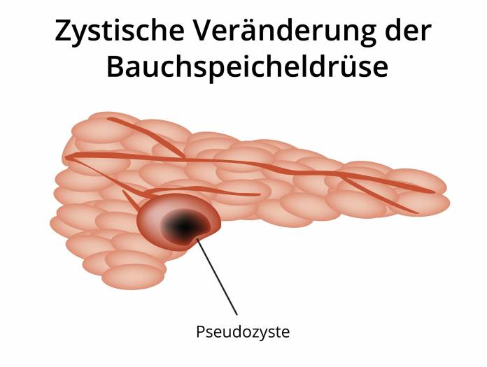 Pseudozyste der Bauchspeicheldrüse