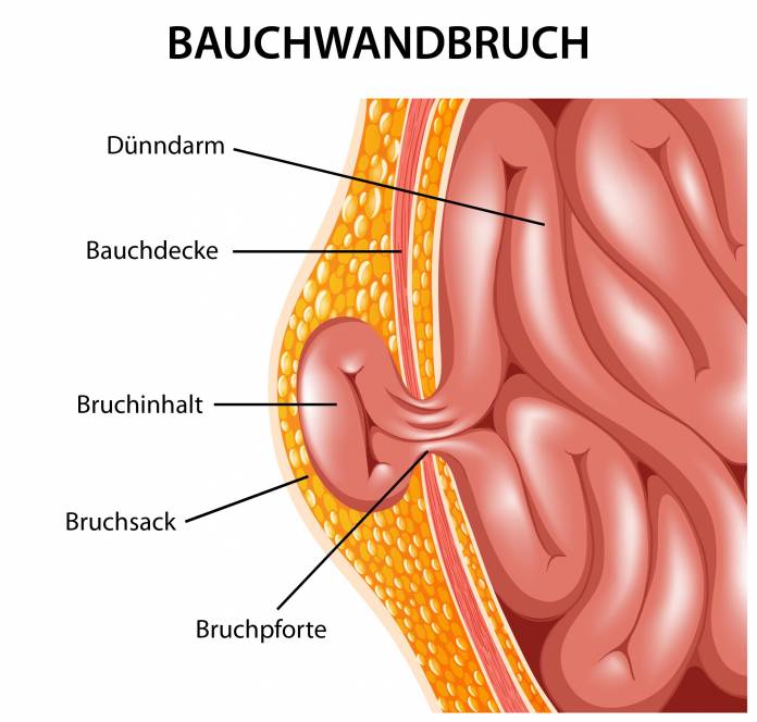 Bauchwandbruch