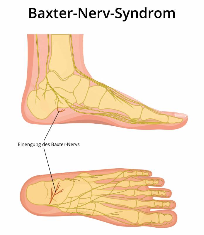 Baxter-Nerv-Syndrom