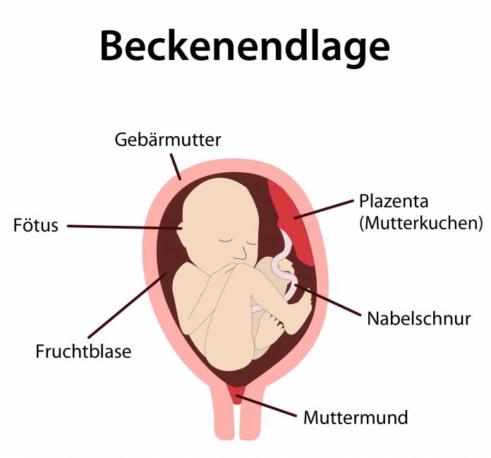 Beckenendlage