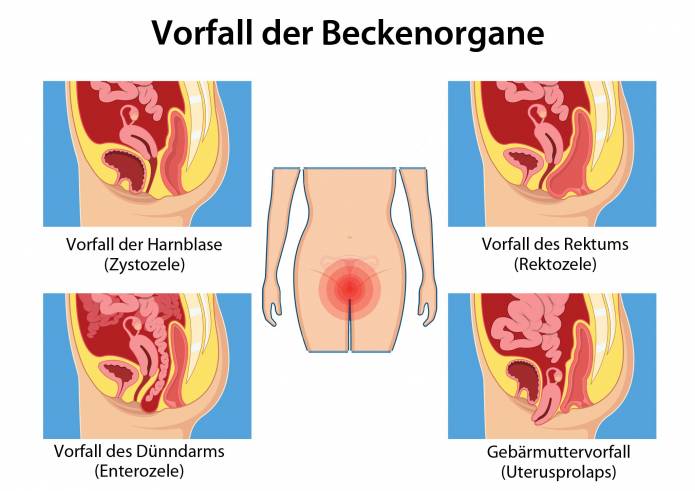 Vorfall der Beckenorgane