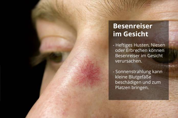 Besenreiser im Gesicht