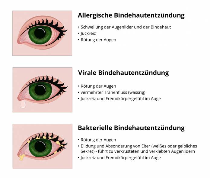 Anzeichen der verschiedenen Arten von Bindehautentzündung