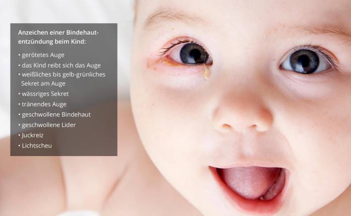 Woran erkennt man eine Bindehautentzündung bei Babys und