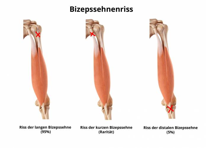 Bizepssehnenruptur