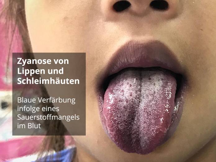 Blaue Lippen durch Sauerstoffmangel