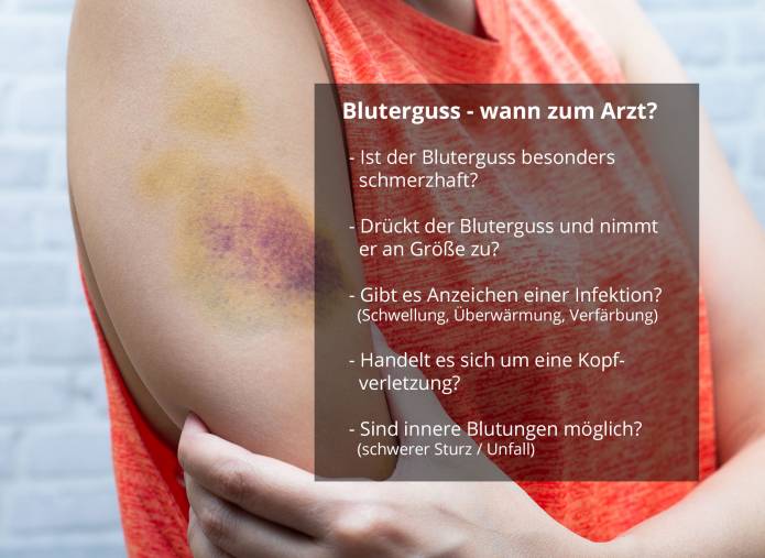 Bluterguss - wann zum Arzt?