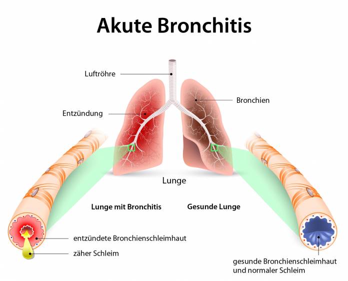 Akute Bronchitis
