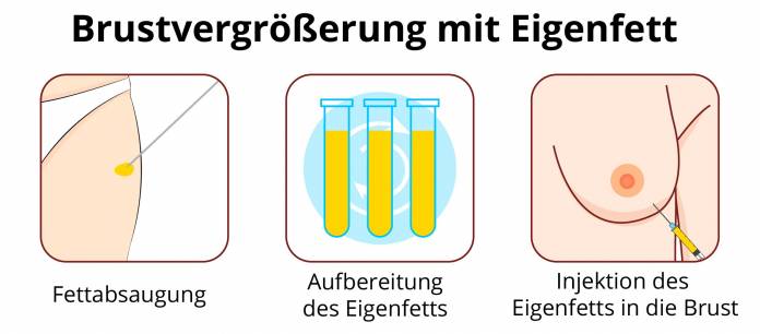 Brust vergrößern mit Eigenfett