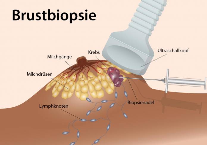 Ablauf einer Brustbiopsie