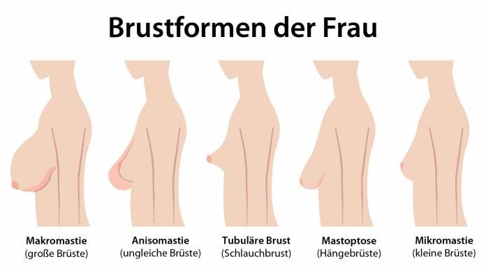 Brustformen der Frau