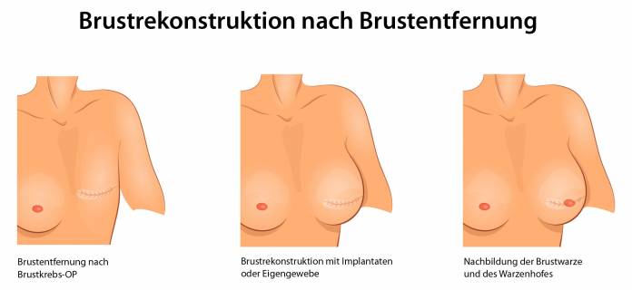 Brustrekonstruktion nach Brustkrebs-OP