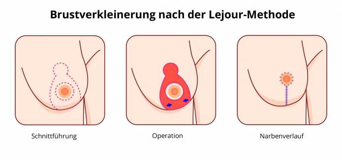 Brustverkleinerung nach Lejour