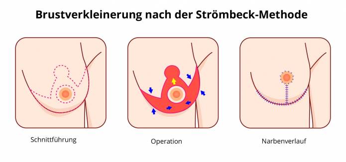 Brustverkleinerung nach der Strömbeck-Methode