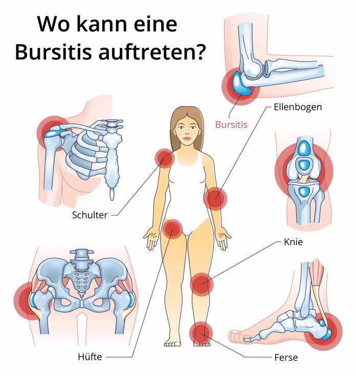 Wo kann eine Bursitis auftreten?