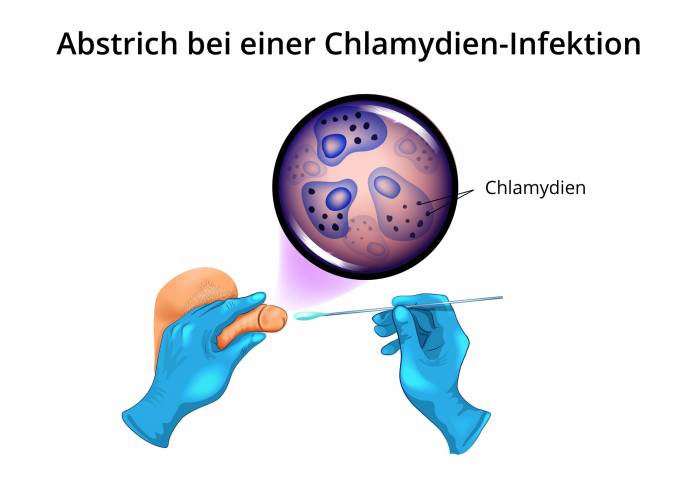 Abstrich bei einer Chlamydien-Infektion