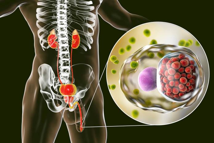 Chlamydien-Urethritis beim Mann